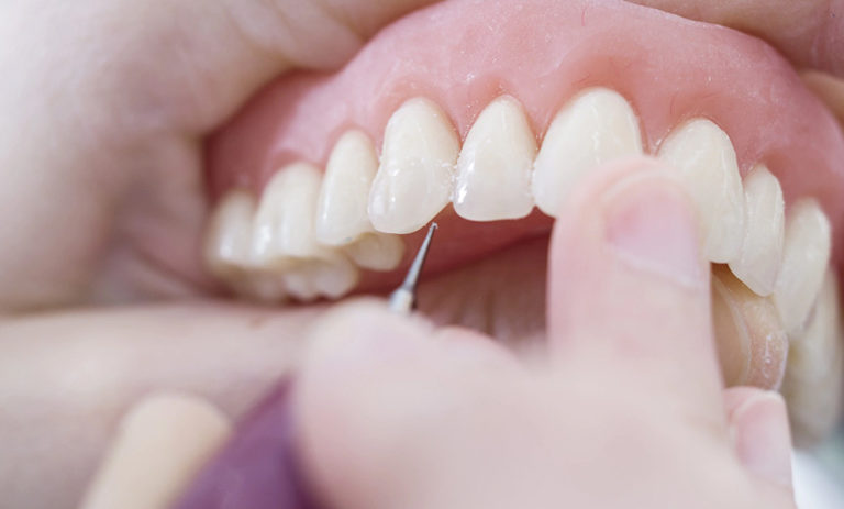 Cuidar las prótesis dentales
